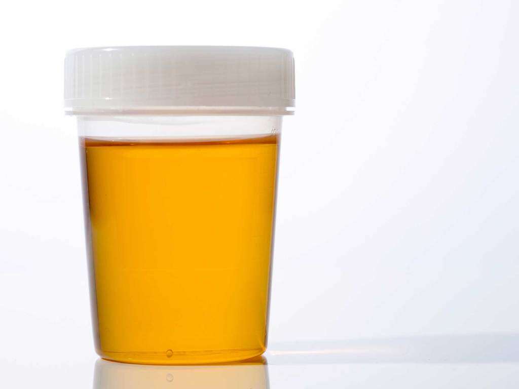 Cloudy Urine 10 Causes Of Cloudy Urine