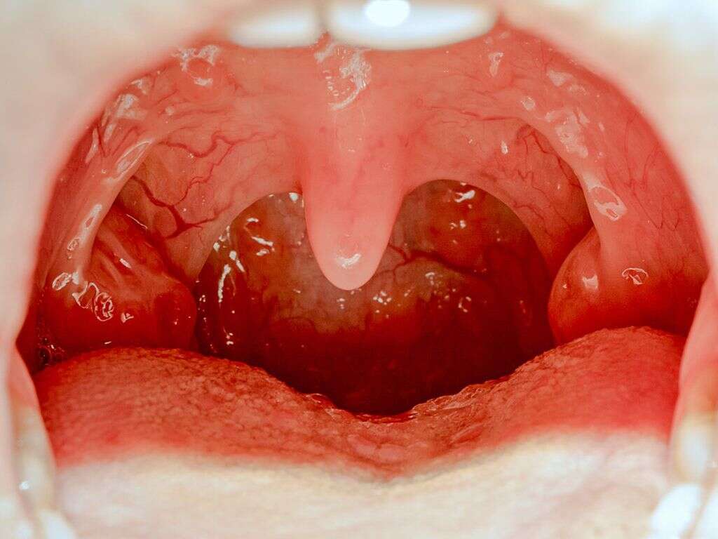 Inflamed Tonsils