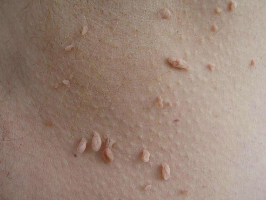normal skin tags private parts