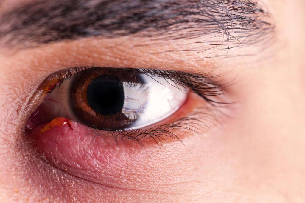 stye-on-eye-10-causes-of-stye-on-an-eye