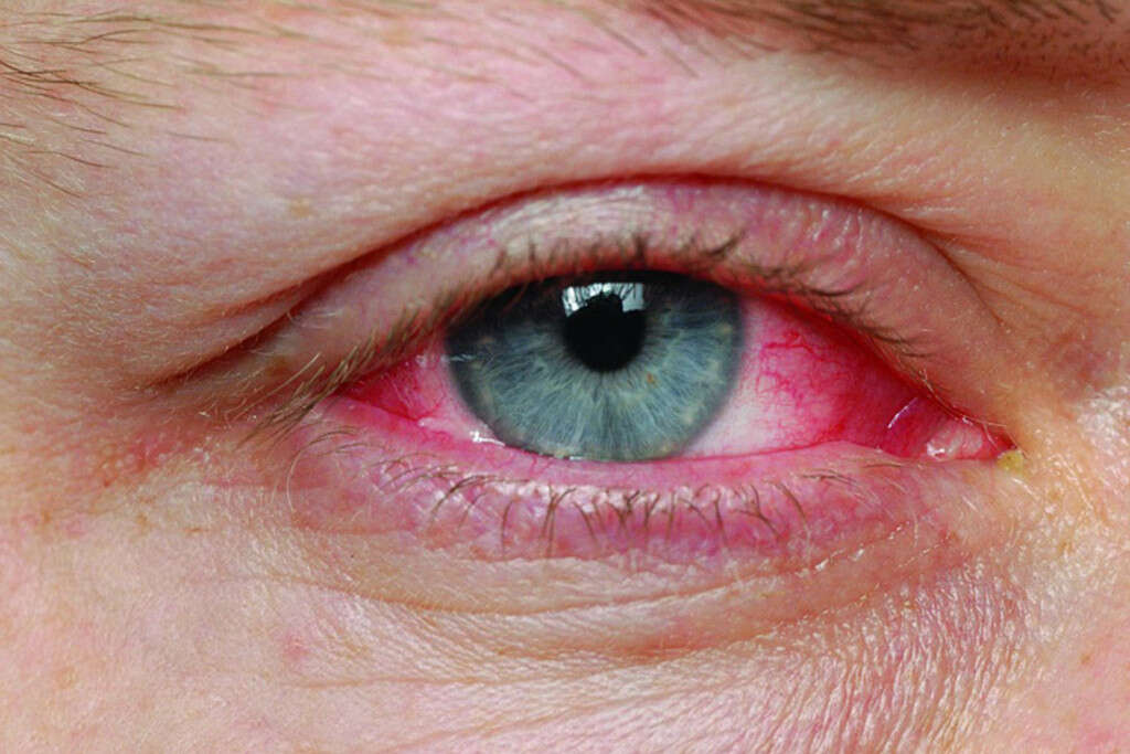 Causes Of Swollen Eyelids 02 