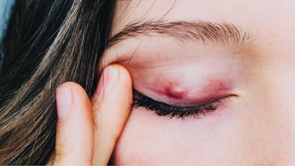 Swollen Eyelids 10 Causes Of Swollen Eyelids 