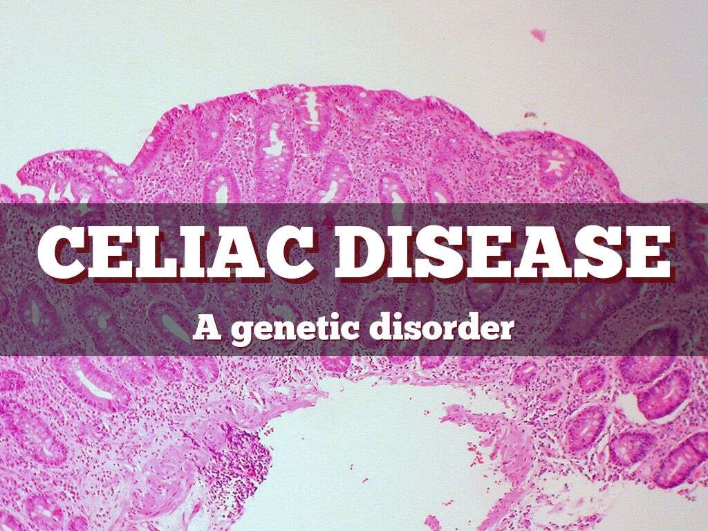 10 Symptoms of Celiac Disease