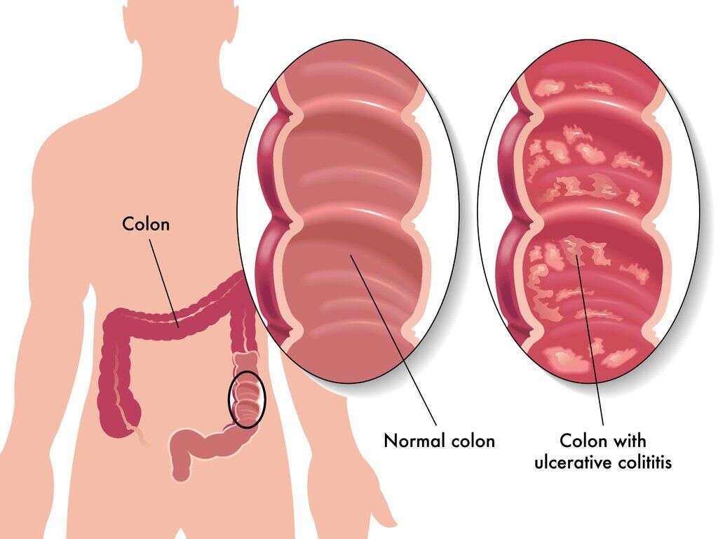 Colitis