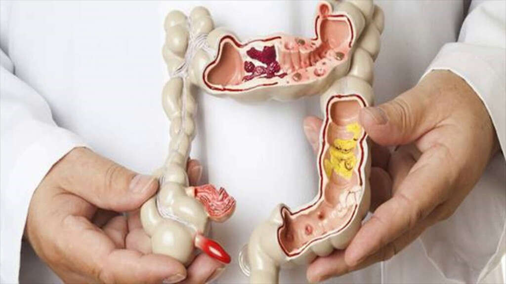 Colorectal Cancer