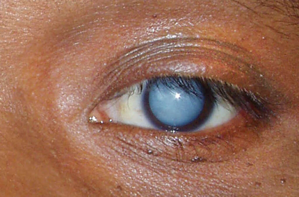 Eye Diseases 10 Common Eye Diseases