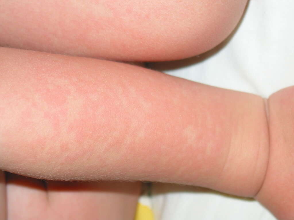 Fifth Disease