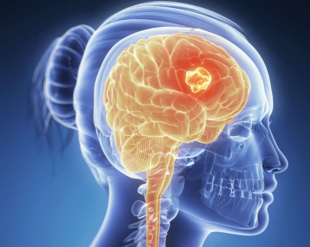 Head Tumor: Head Tumor Symptoms