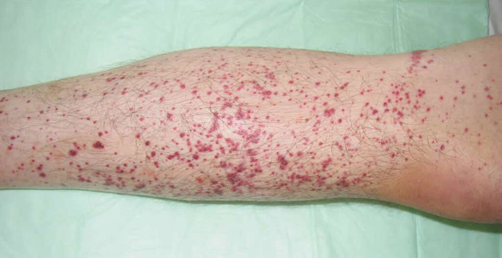 Hemangioma