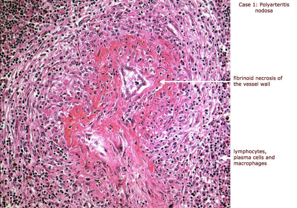 Hepatitis B