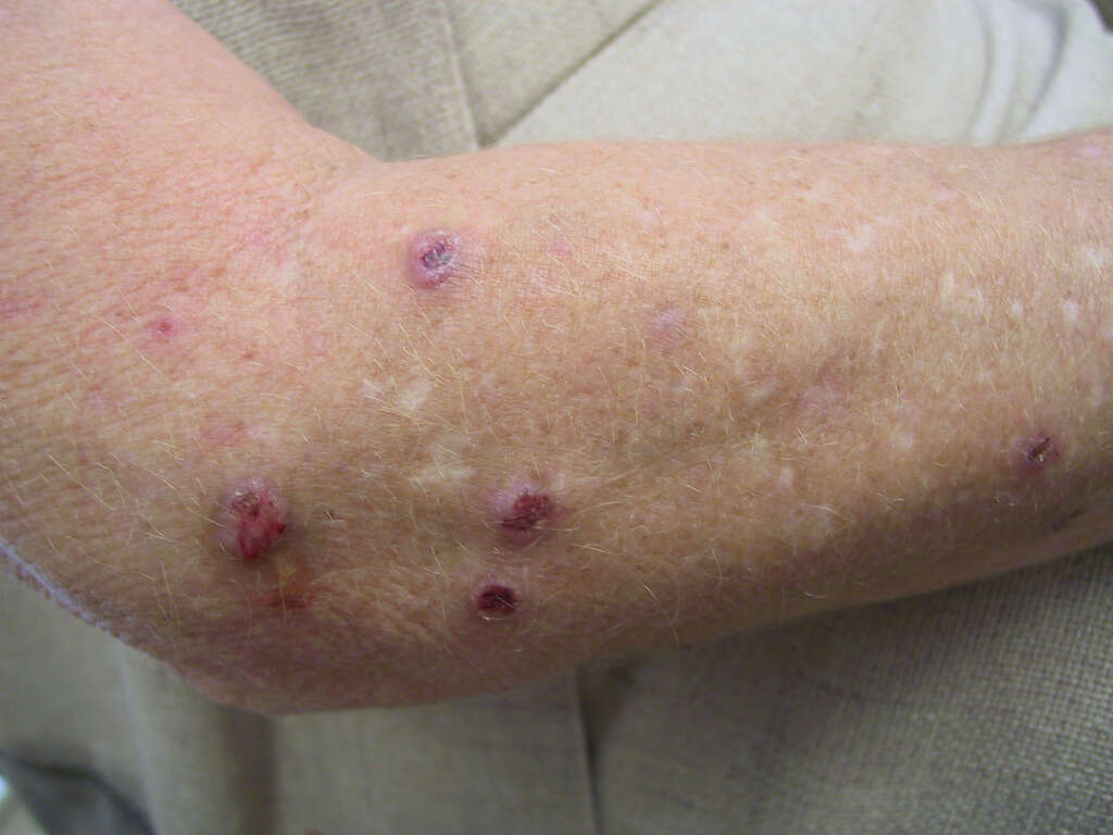 10 Hepatitis C Symptoms