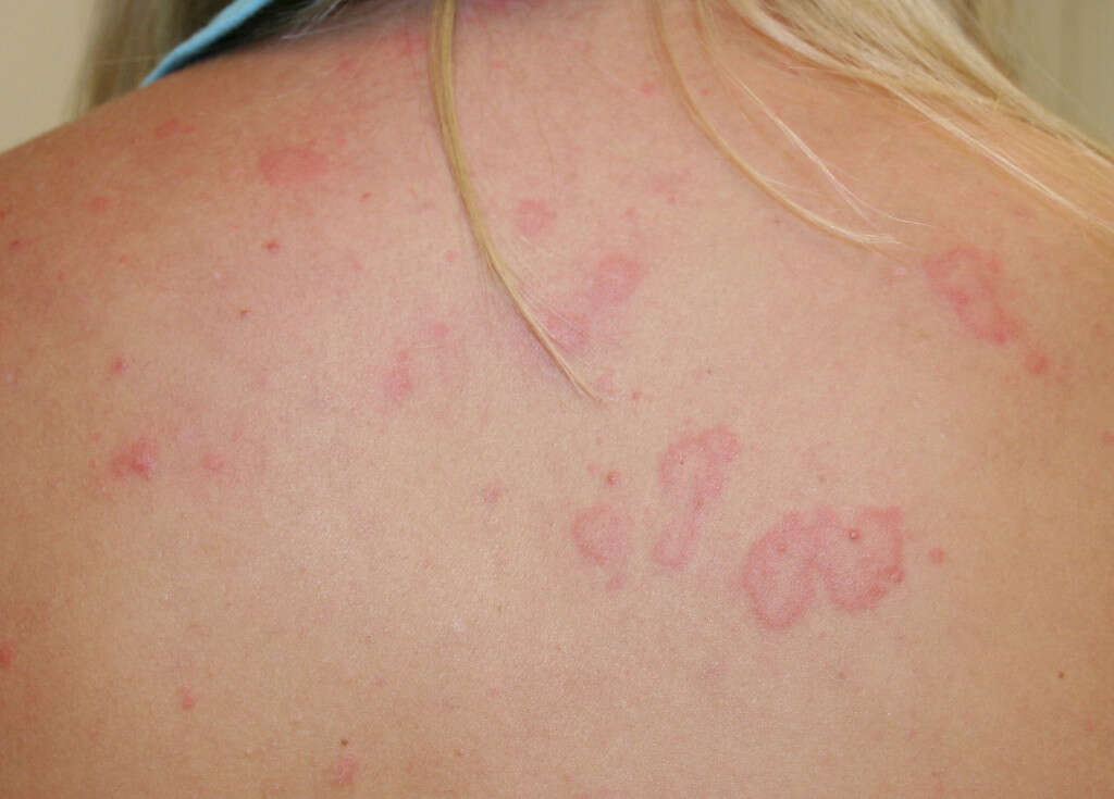 Urticaria And Skin Rashes Signs Causes Treatment Symptoms Images Images