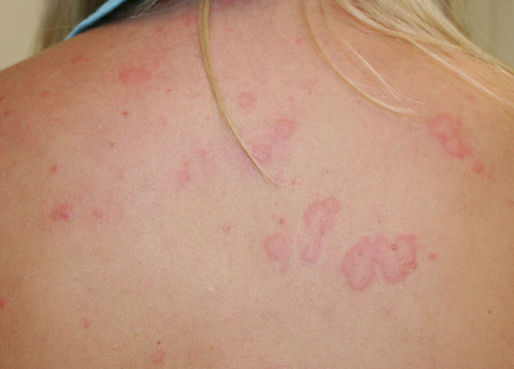 Hives 10 Symptoms Of Hives