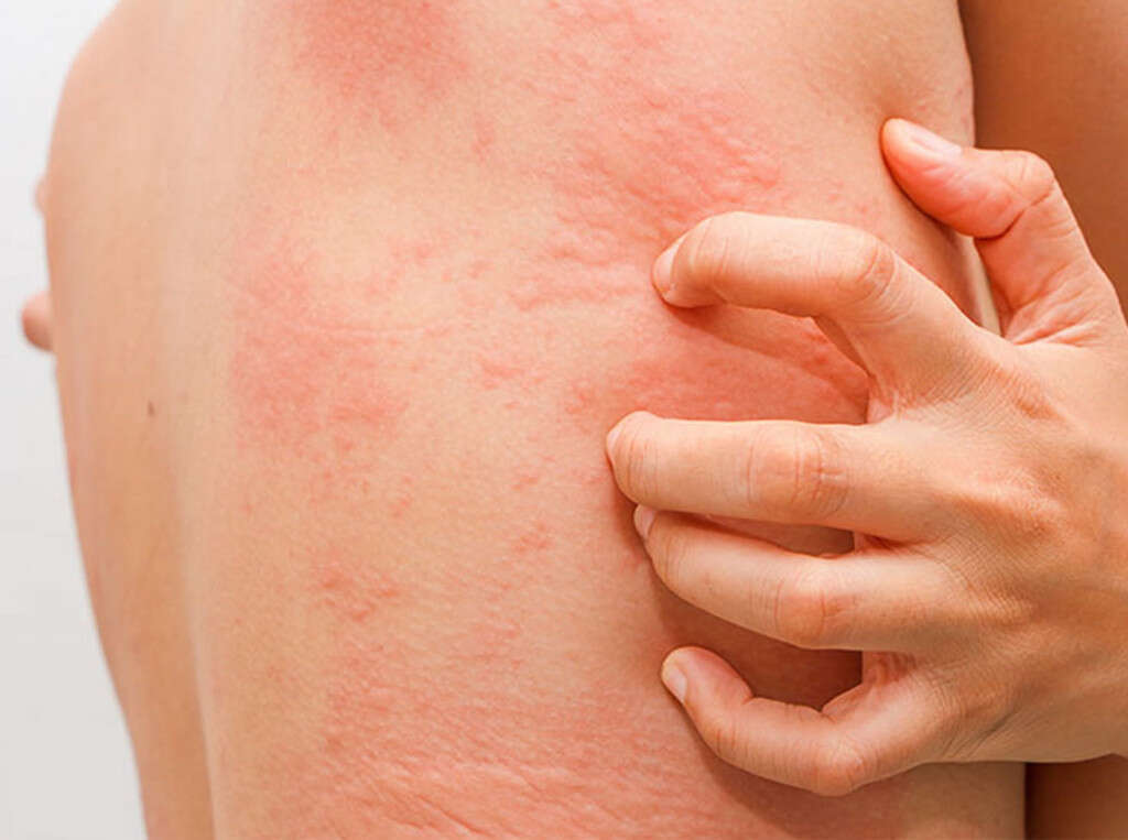 hives-10-symptoms-of-hives