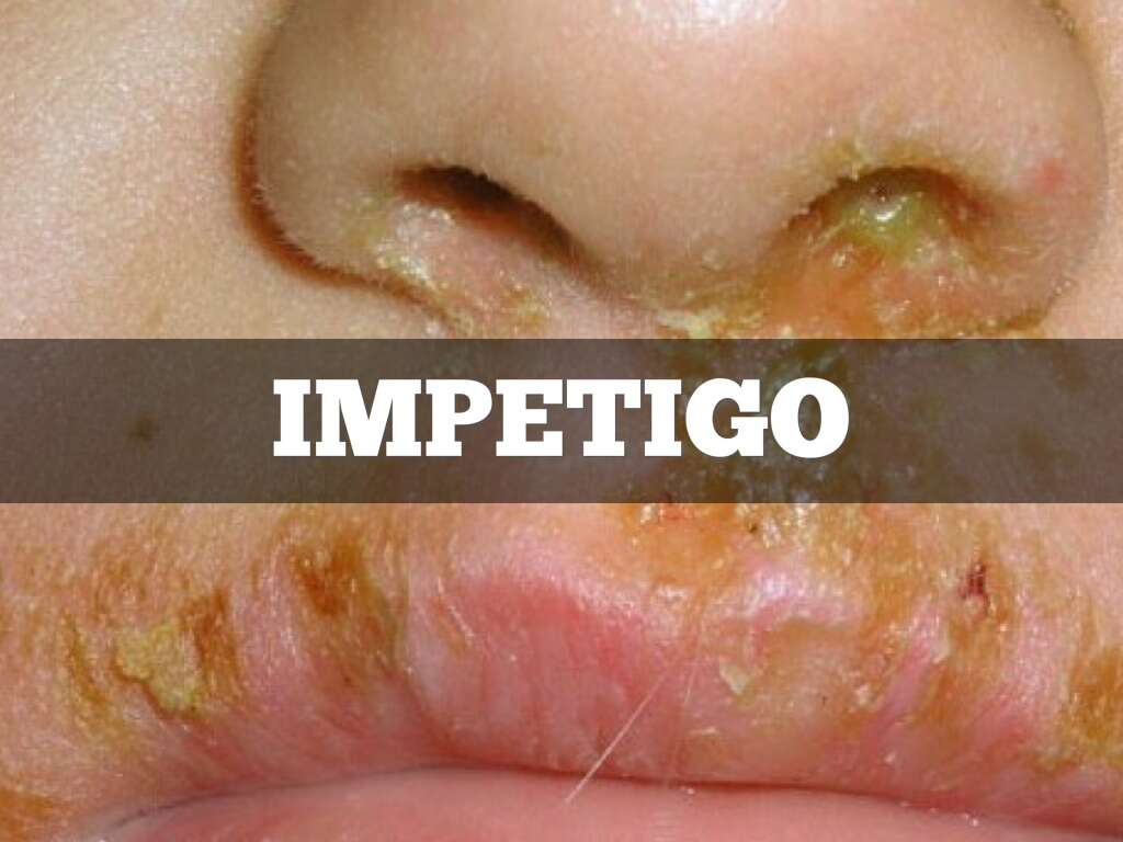 How To Describe Impetigo