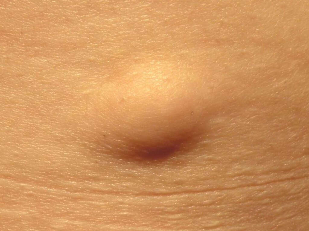 10 Causes of Lipoma