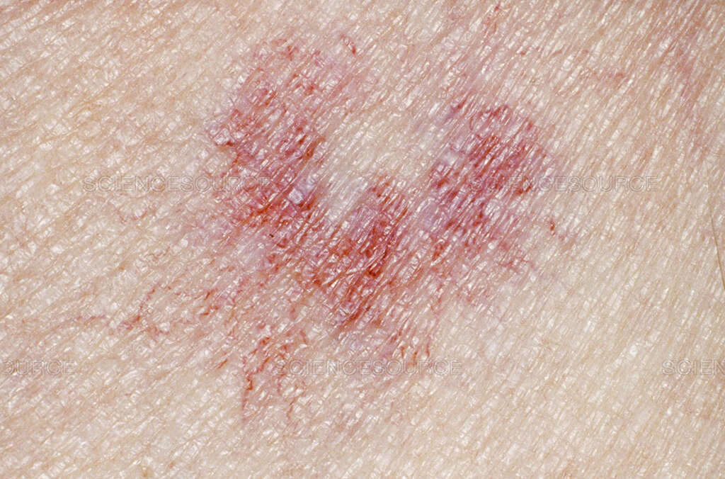 Liver Disease Spots On Skin