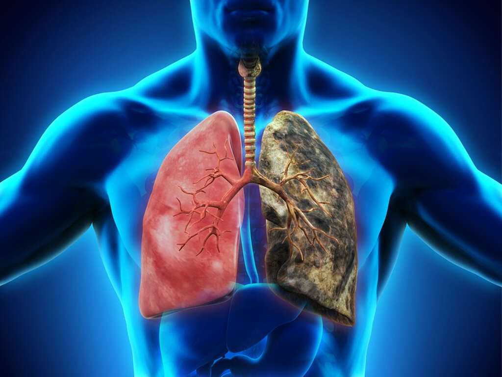 10 Lung Infection Symptoms