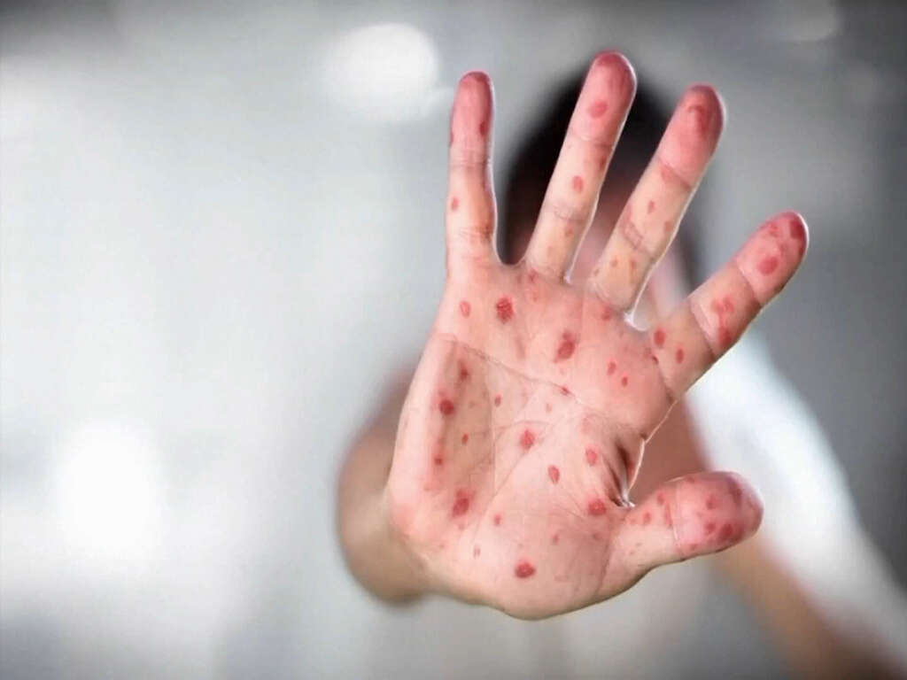 Measles 10 Symptoms Of Measles