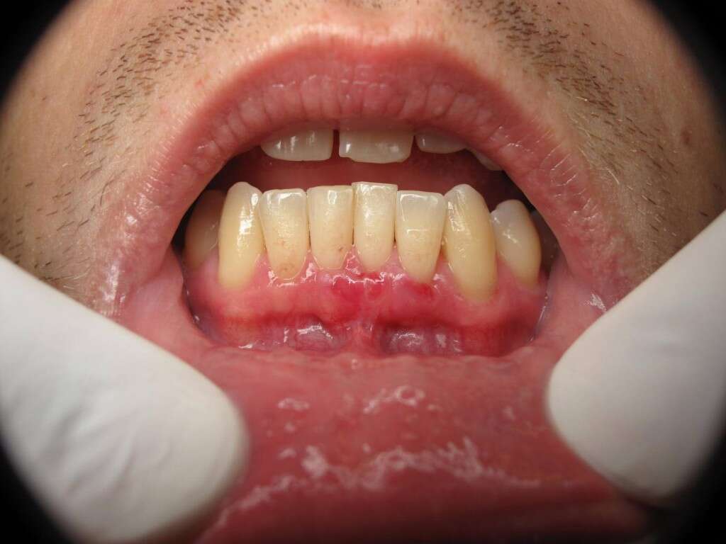 What Does Mouth Cancer Look Like From Chewing Tobacco at Joan Long blog