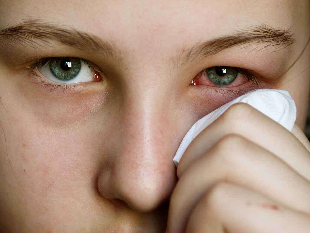 Pink Eye Causes, Symptoms & Treatments