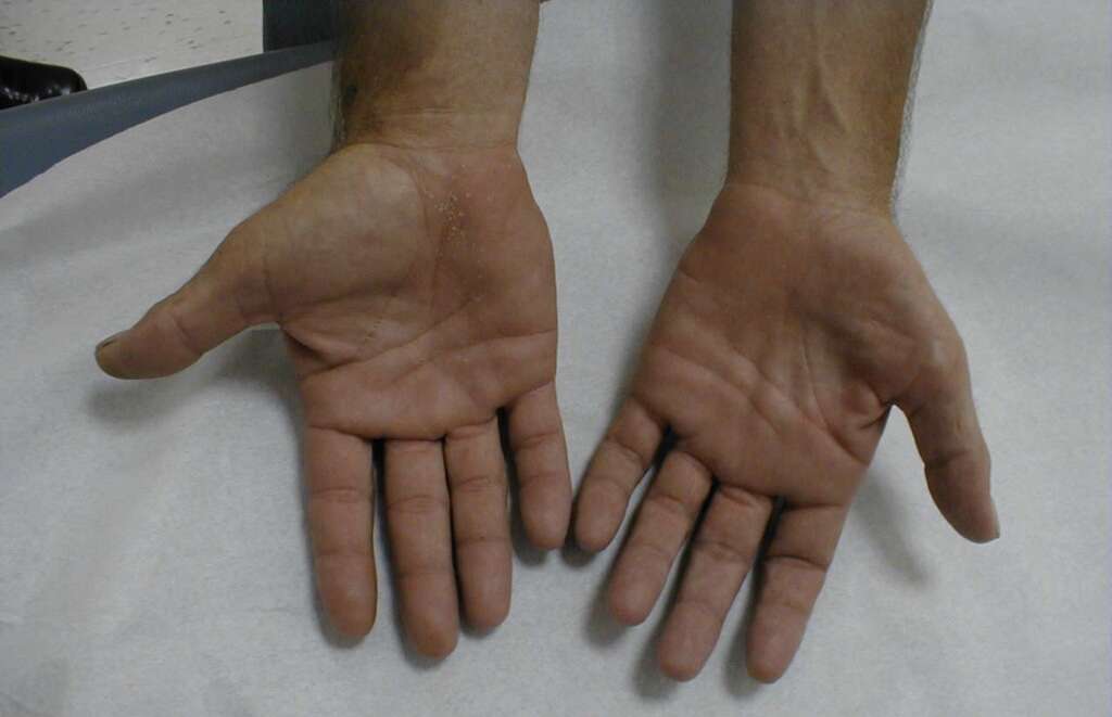 RSD (Reflex Sympathetic Dystrophy)(Reflex Sympathetic Dystrophy)