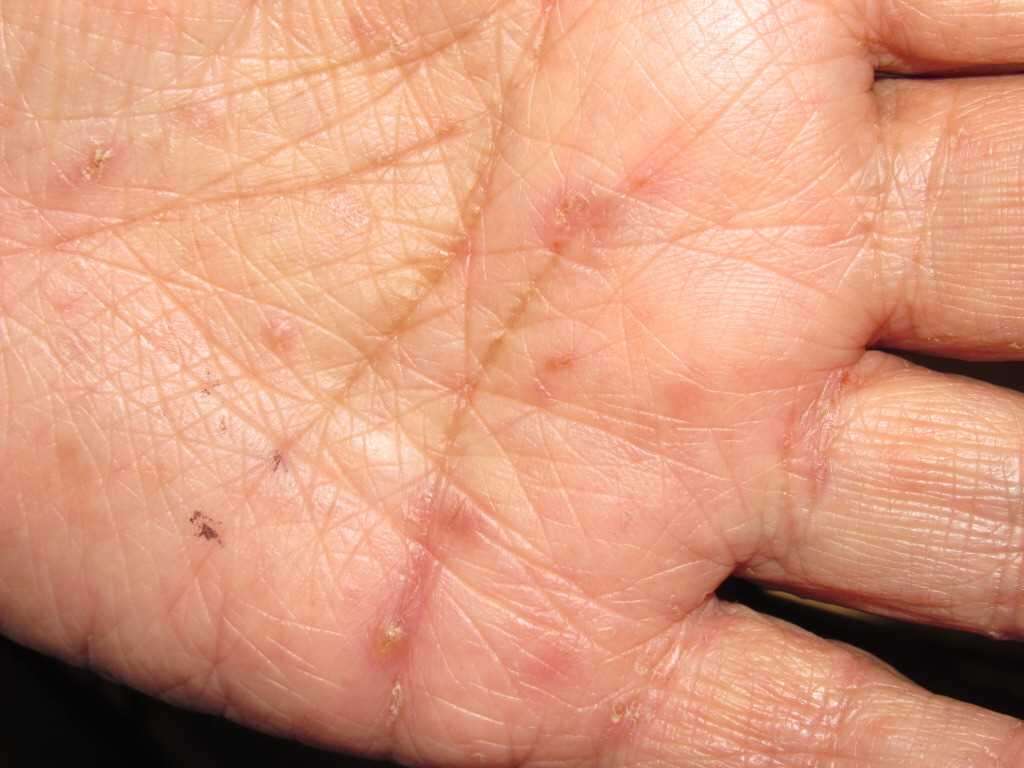 Scabies Scabies Symptoms And Treatments