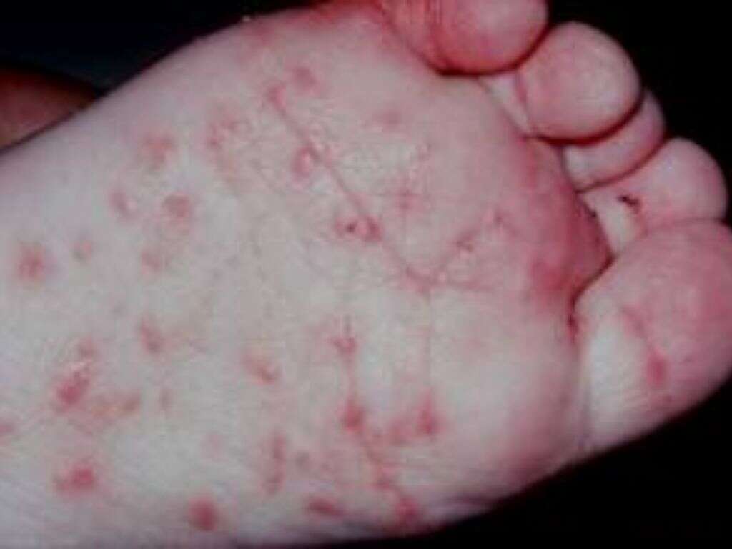 Scabies