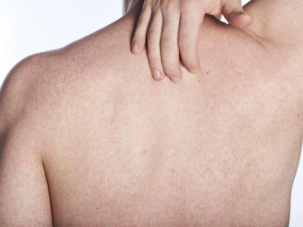 Scarlet Fever 10 Symptoms Of Scarlet Fever