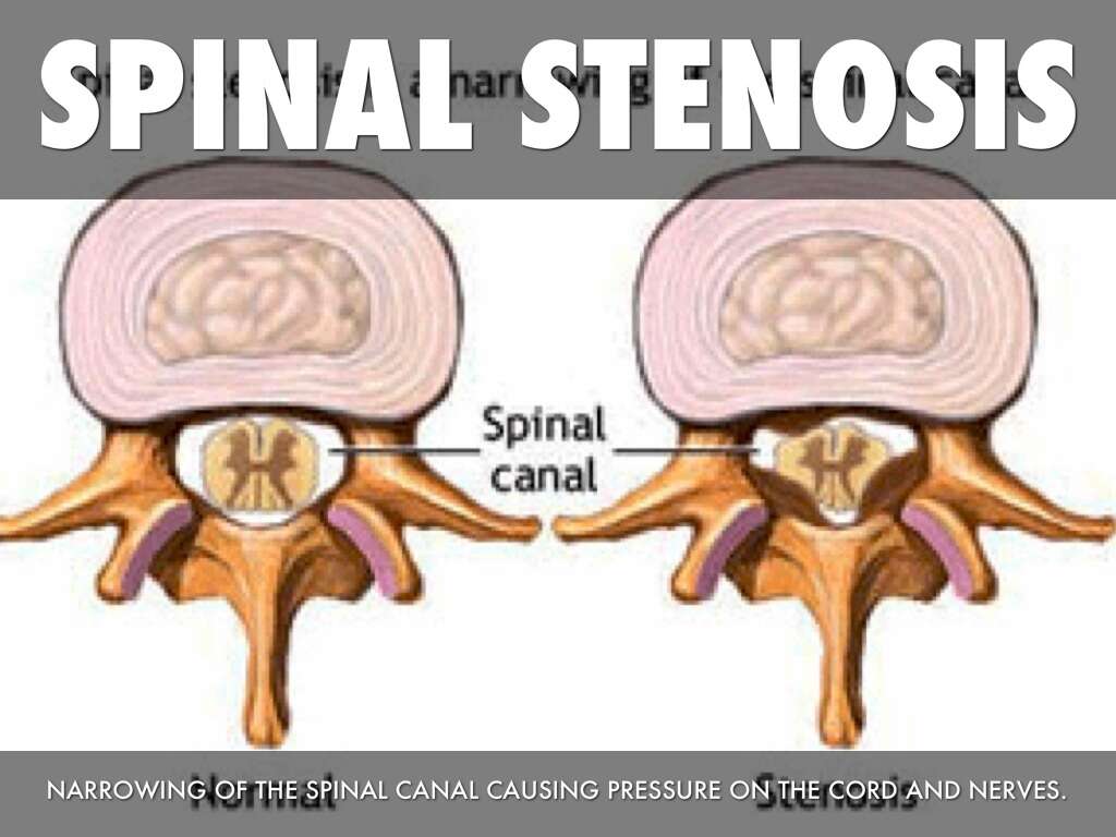 Spinal Stenosis