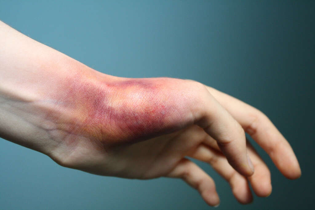 sprained-wrist-10-symptoms-of-a-sprained-wrist