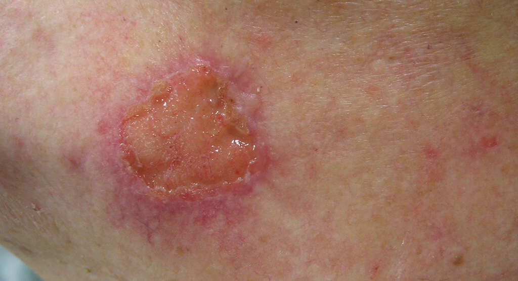 squamous cell carcinoma treatment