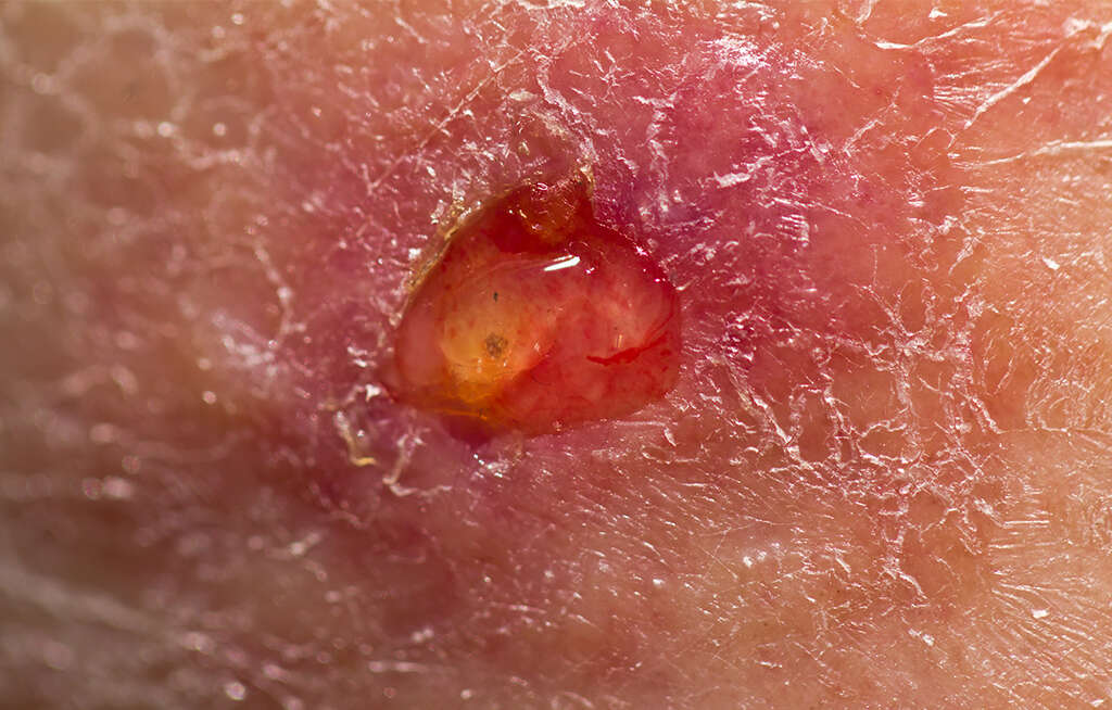 Squamous Cell Carcinoma