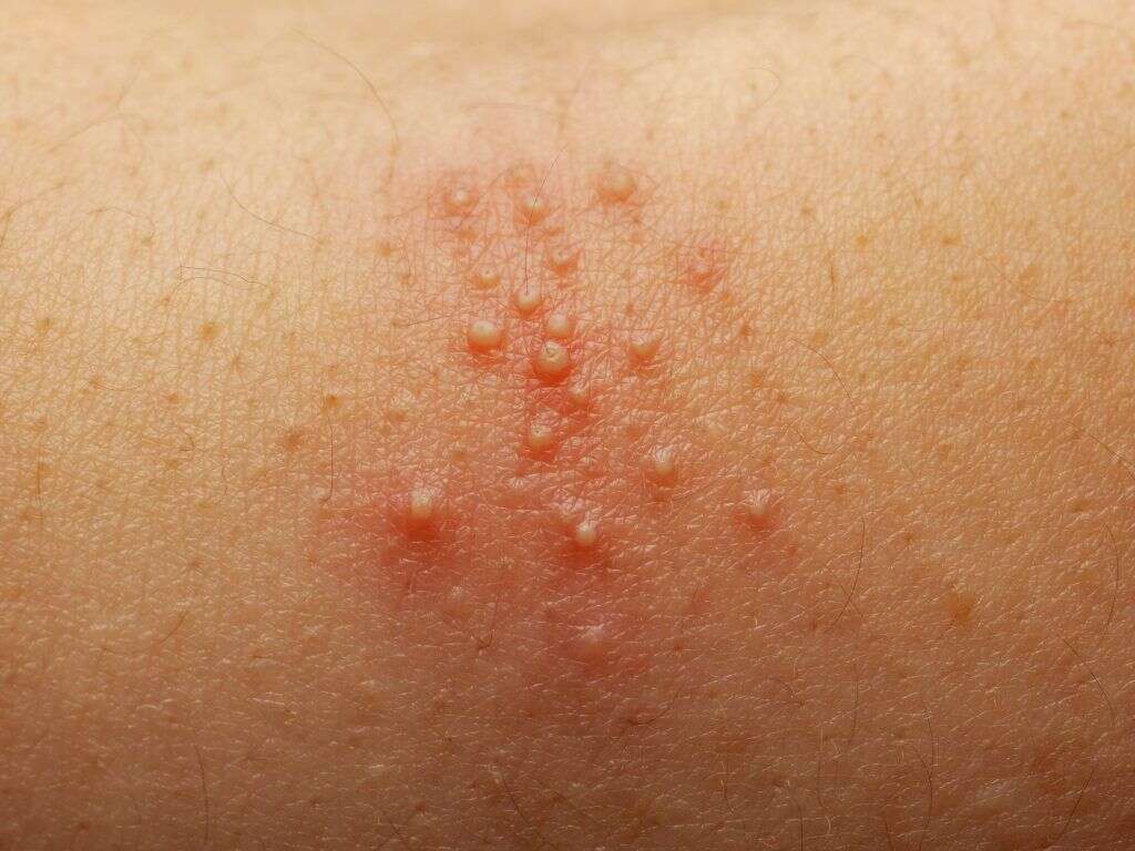 Staph Infection 10 Staph Infection Symptoms