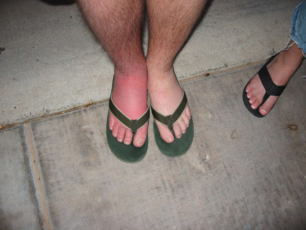 Swollen Ankles