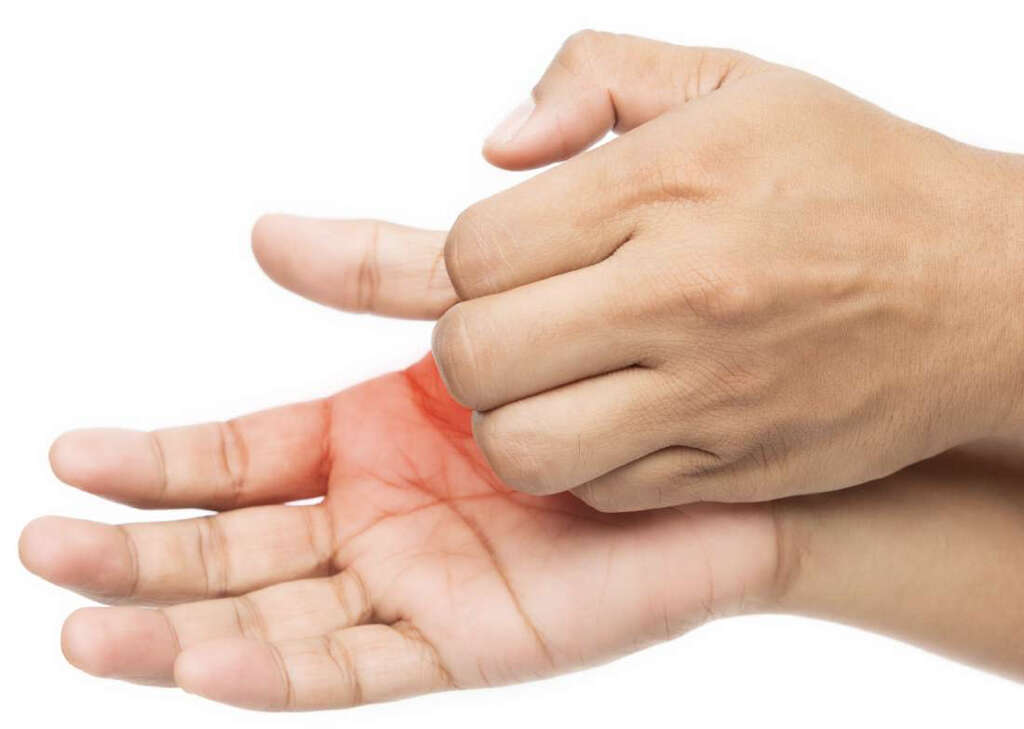 chilblains-10-symptoms-of-chilblains