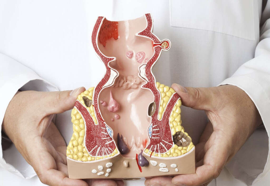 Clostridium Difficile