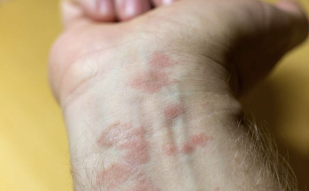 causes-of-rash-that-comes-and-goes-its-treatment