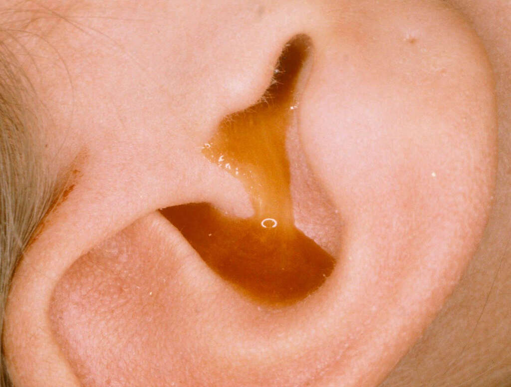 Ear Infection In Babies
