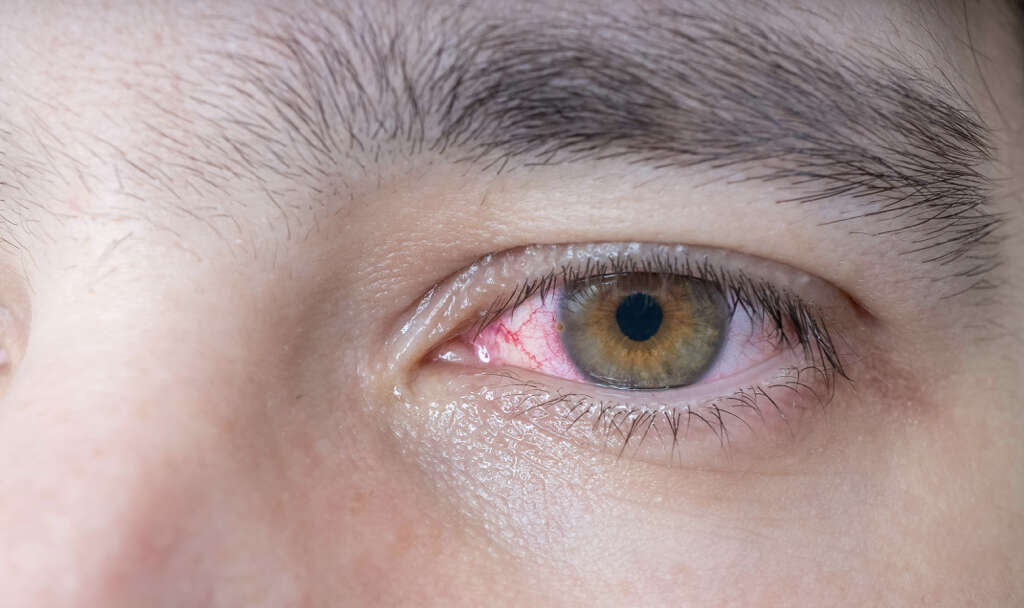 Que Es Cancer Ocular