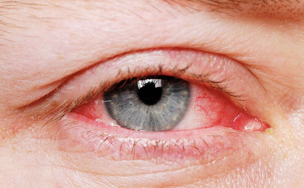 Eye Cancer 10 Symptoms Of Eye Cancer