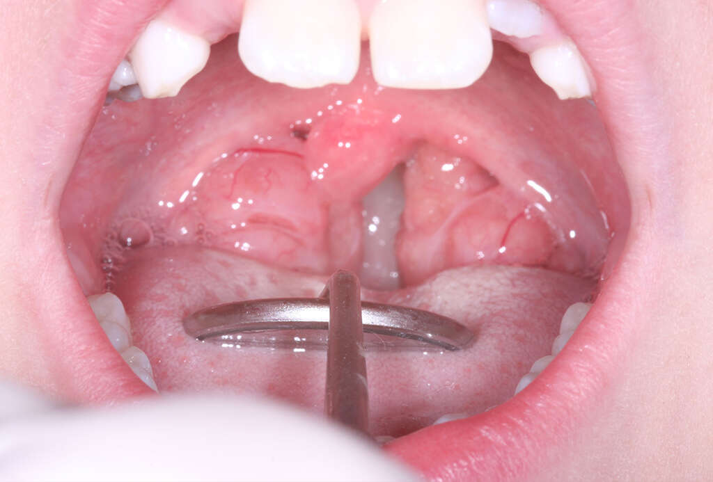 Pharyngitis