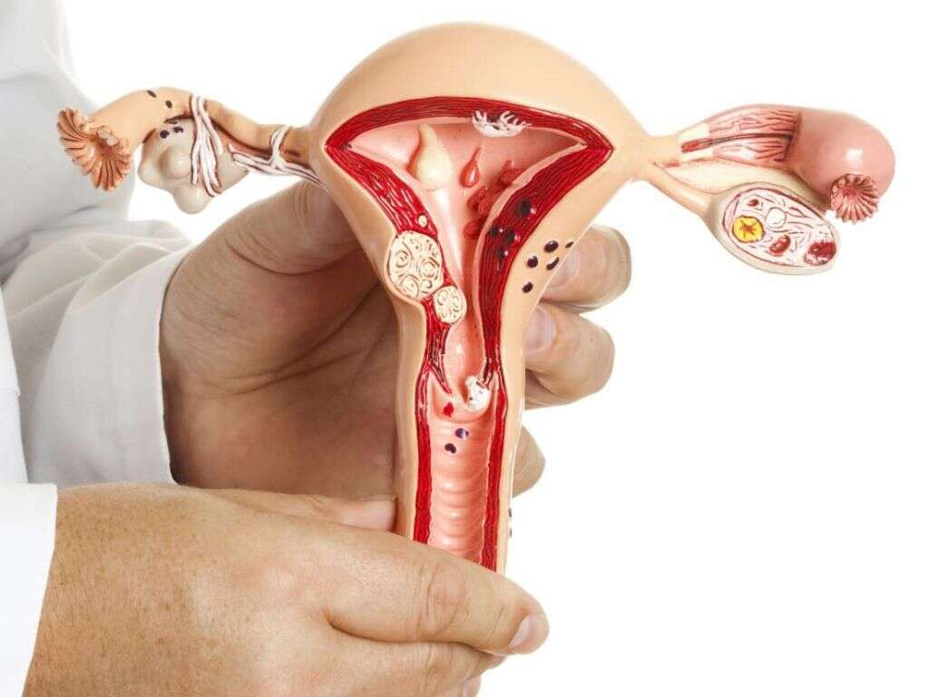 Uterine Fibroids