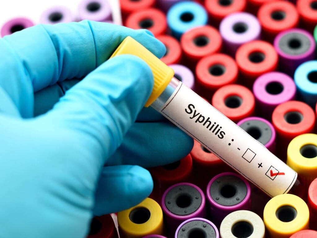10 Syphilis Symptoms