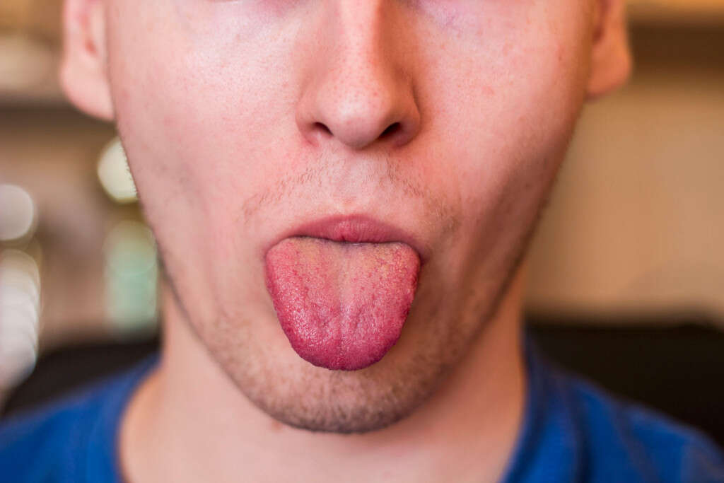 Cancer Spots On Tongue