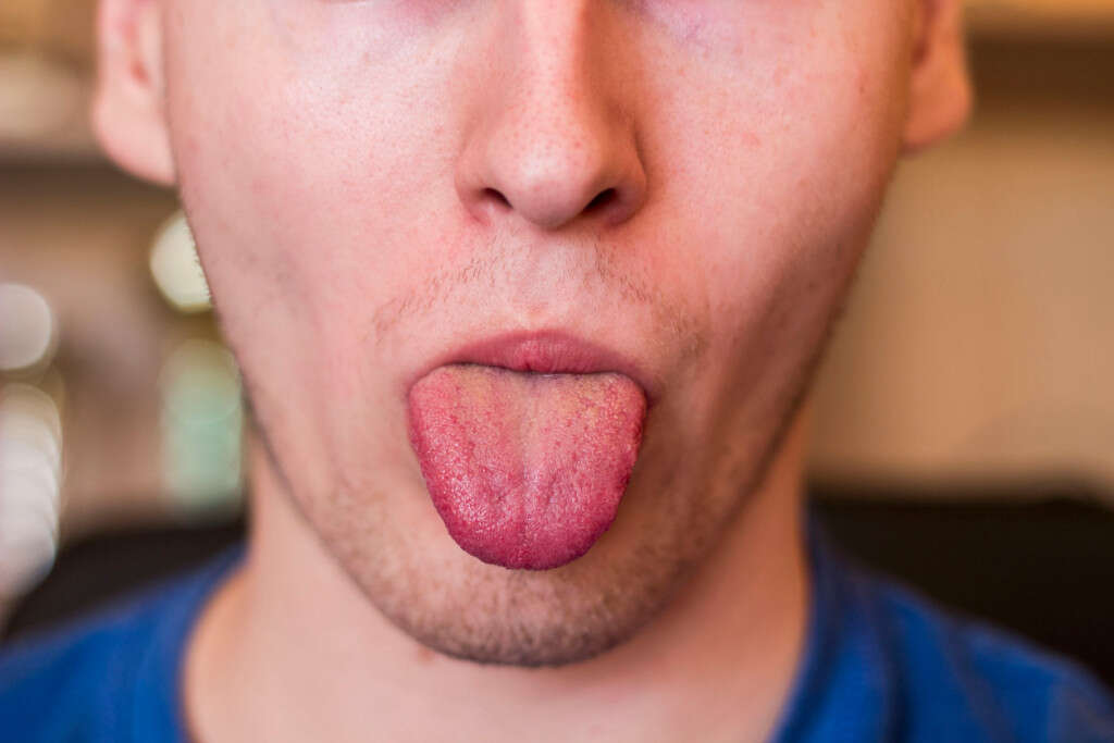 Tongue Cancer 10 Tongue Cancer Symptoms