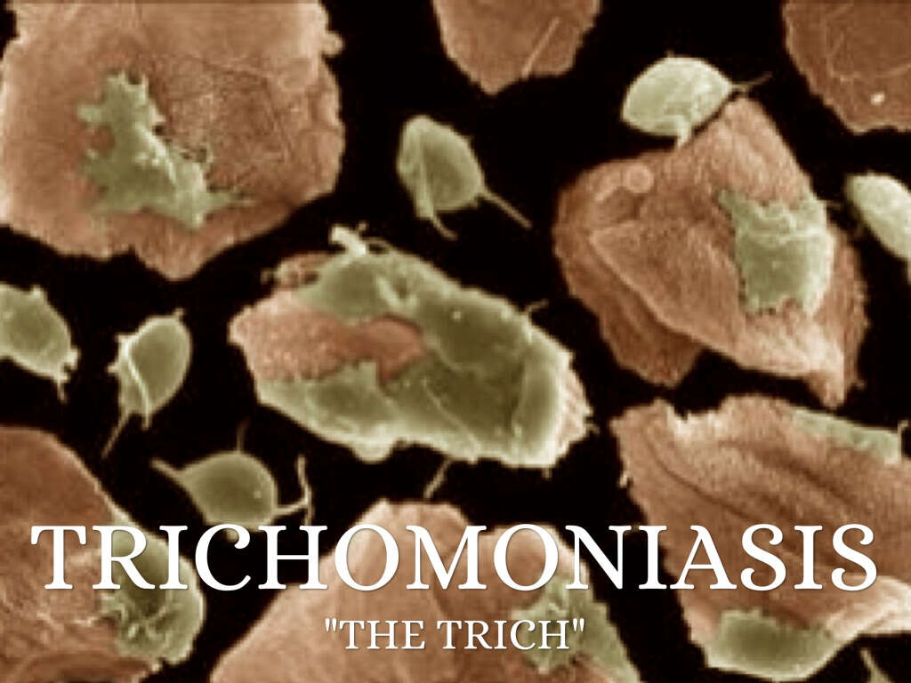 10 Symptoms of Trichomoniasis