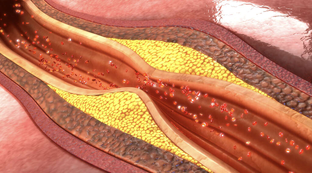 clogged-arteries-what-are-clogged-arteries