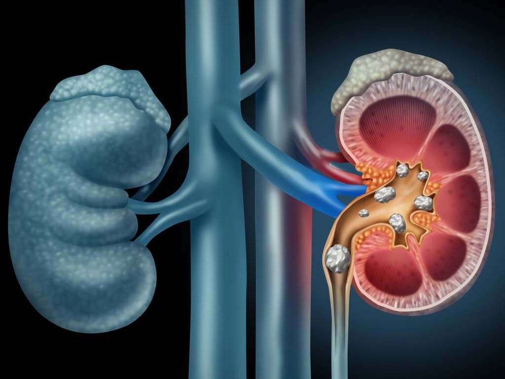 What Causes Kidney Stones?