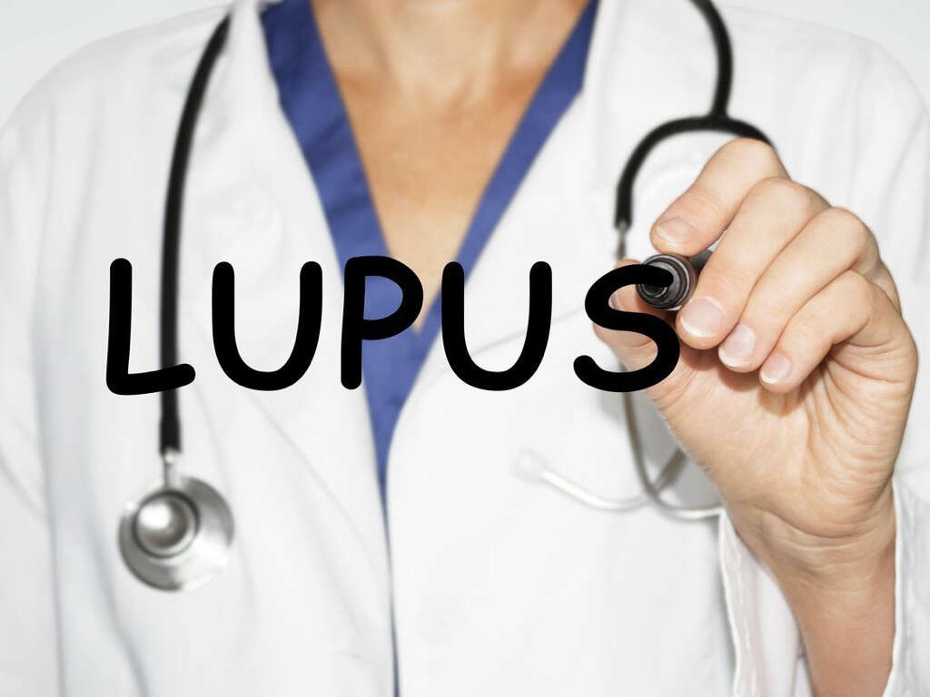 Lupus